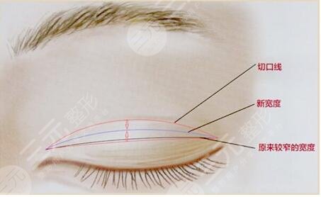 成都双眼皮修复案例