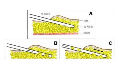 面部吸脂科普知识
