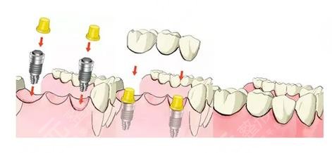 牙齿种植原理