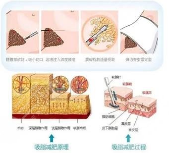 吸脂过程