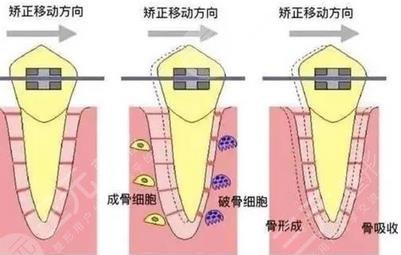 牙齿矫正过程