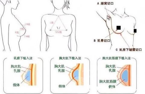 隆胸技术科普