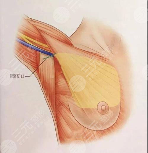 深圳北大医院隆胸案例效果图