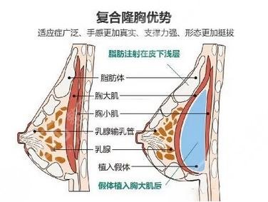 隆胸手术