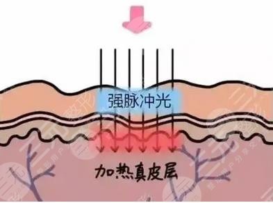 烧伤修复