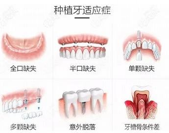 种植牙适应症