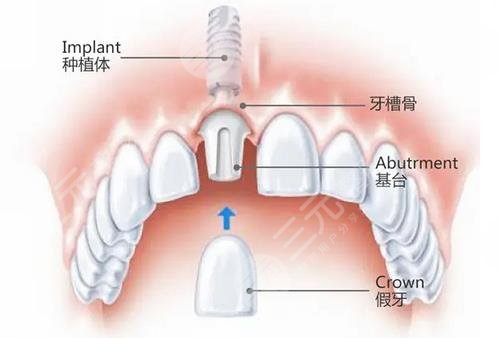 种植牙原理