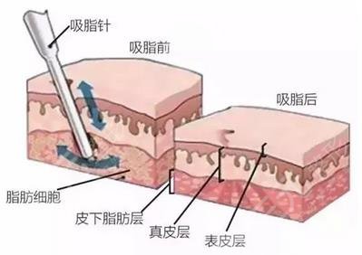 吸脂原理