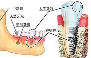 牙齿种植原理