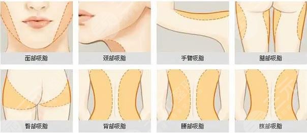 吸脂瘦身部位