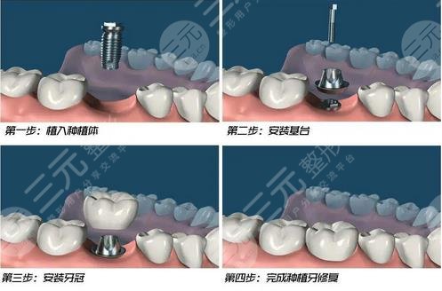 北京种植牙医院排名前十公布！最新排名，盘点前5实力派医院~