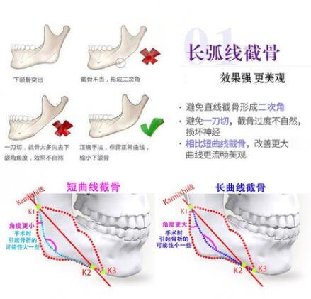 上海下颌角磨骨案例