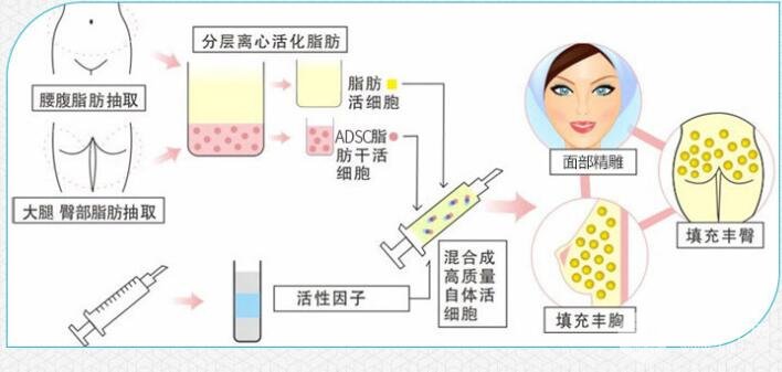 自体脂肪填充的优势盘点