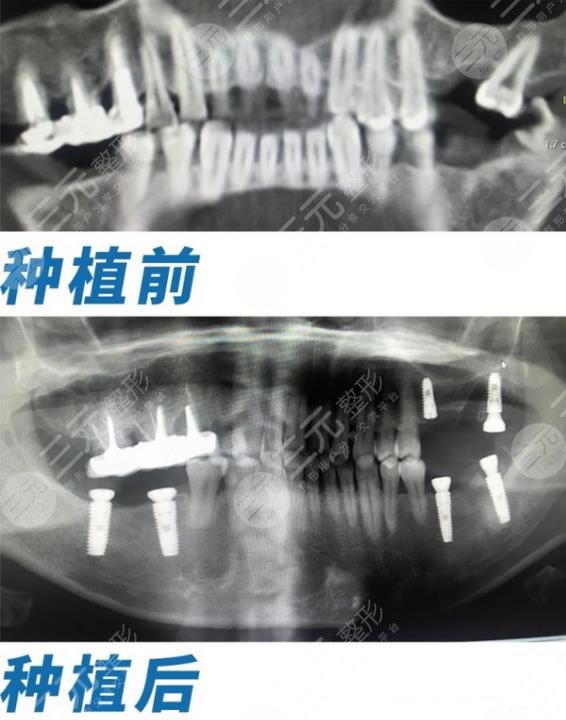 大庆康美口腔种植牙经历分享