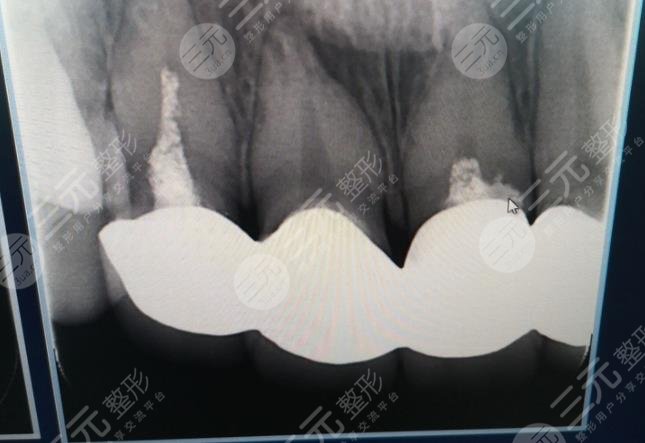 郑州赛思口腔医院全瓷牙经历分享