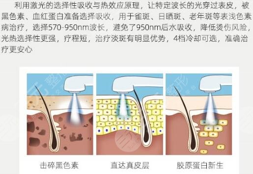 激光美容科普