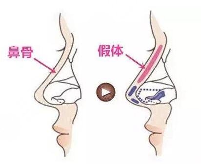 西安西京整形医院隆鼻案例