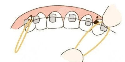 济宁口腔医院牙齿矫正案例