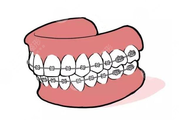 牙齿矫正项目相关科普介绍