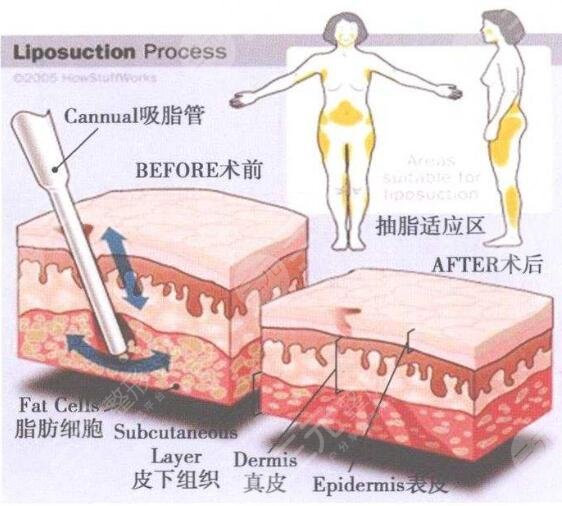 北京亚馨医院面部吸脂案例