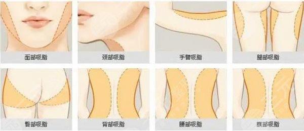 临沂市人民医院可以抽脂吗？抽脂技术成熟&设备完整，在当地人气在线！