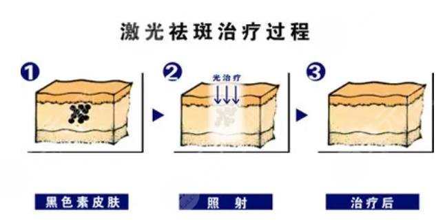 激光祛斑