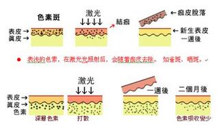 西宁华美智能激光祛斑原理