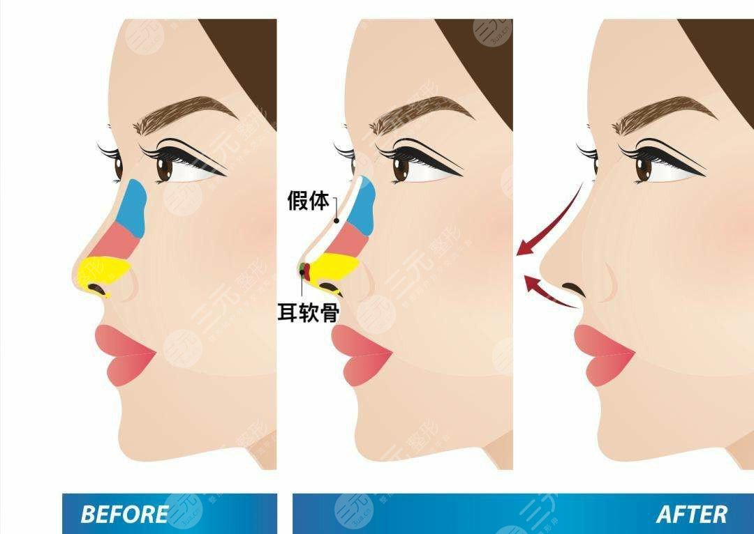 陕西西安西京医院整形隆鼻前