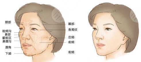 上海亚太整形做面部填充案例
