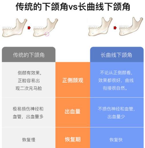 佛山禅城中心医院徐威强教授科普下颌角磨骨