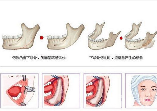 上海港华医院磨骨怎么样