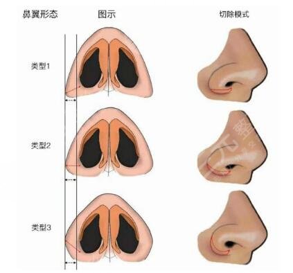 上海伯思立做鼻子哪个医生技术好?