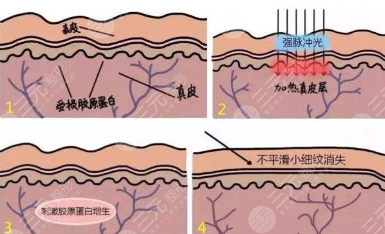 光子嫩肤有哪些缺点呢?