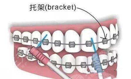 南京金属矫正牙齿项目案例体验反馈：