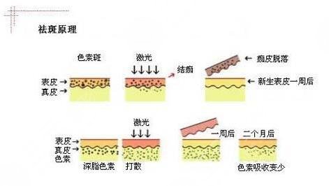 上海容妍整形医院激光祛斑案例