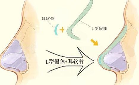 苏州美贝尔鼻部手术整形是指什么?