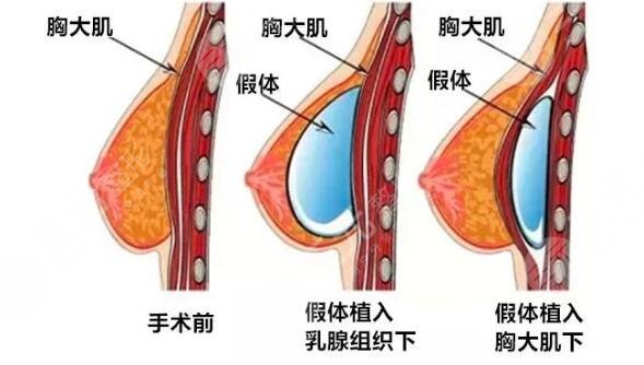 广州隆胸真人案例