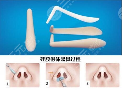 广州颜所隆鼻案例