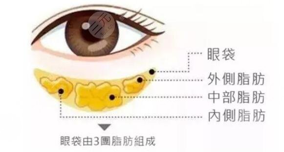 大连去眼袋手术案例反馈