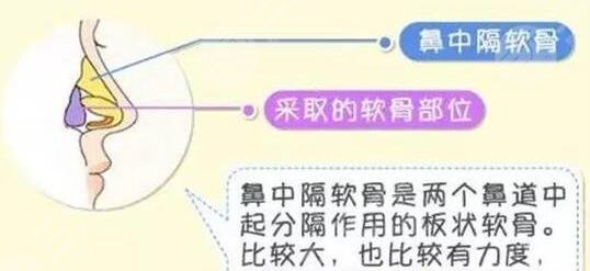 惠州隆鼻整形案例反馈