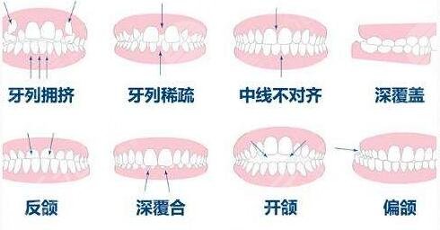 南京牙齿矫正项目案例体验反馈：