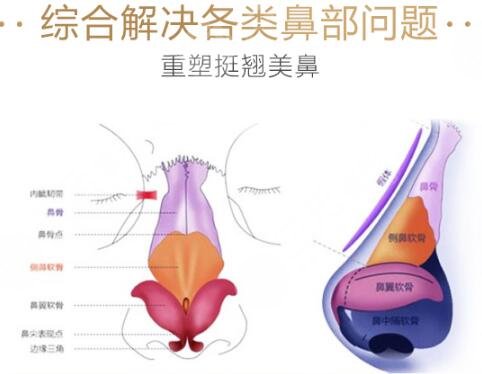 昆明艺星医疗美容医院科普鼻部整形手术