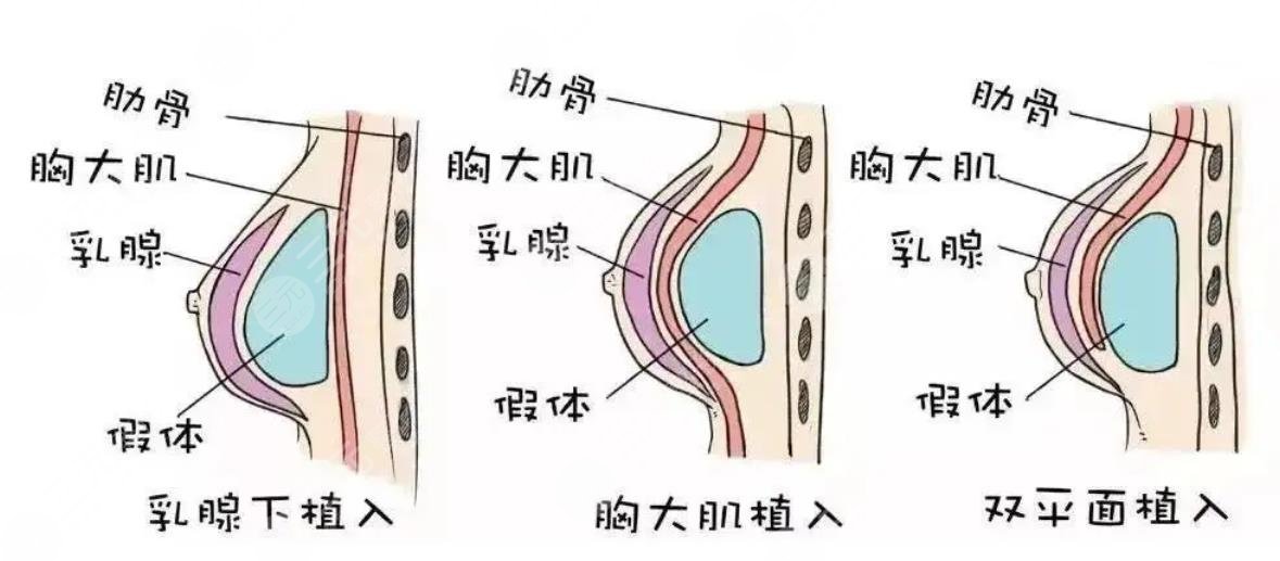 隆胸手术要多久后才能过正常生活？危害和后遗症有什么？附注意事项~