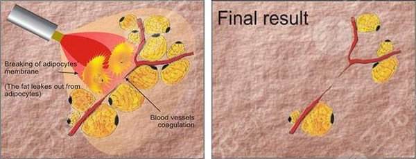 腿部吸脂有什么后遗症