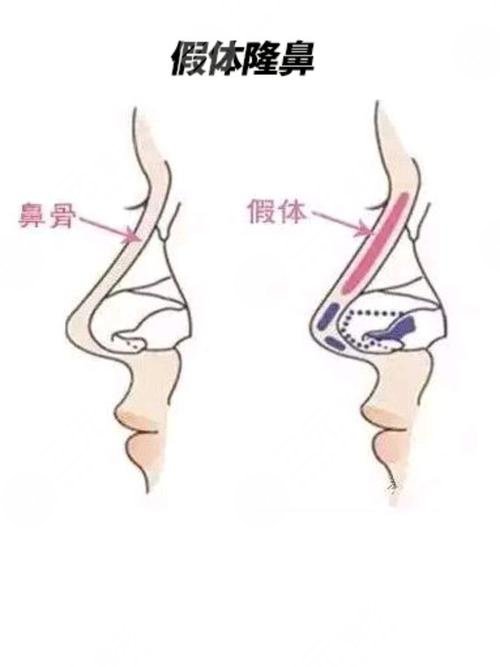 硅胶隆鼻有哪些优势