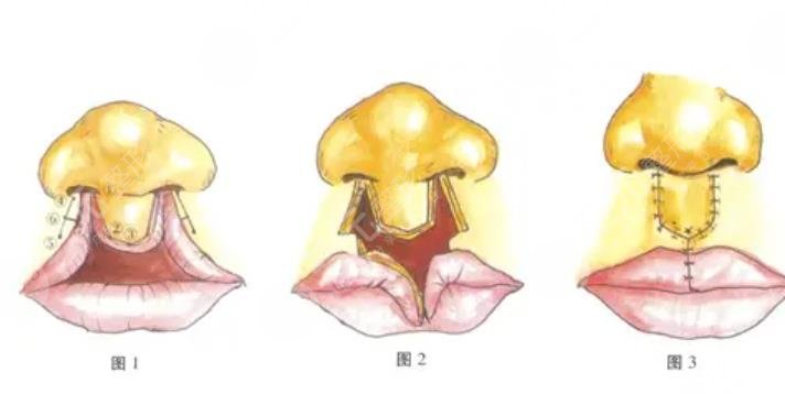 唇裂修复