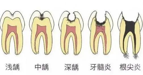 根尖炎