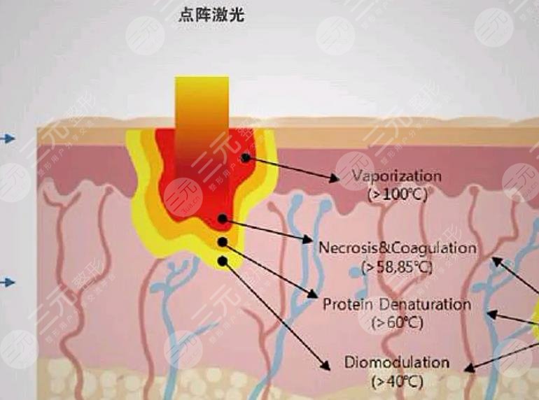 淄博市中心医院点阵激光案例