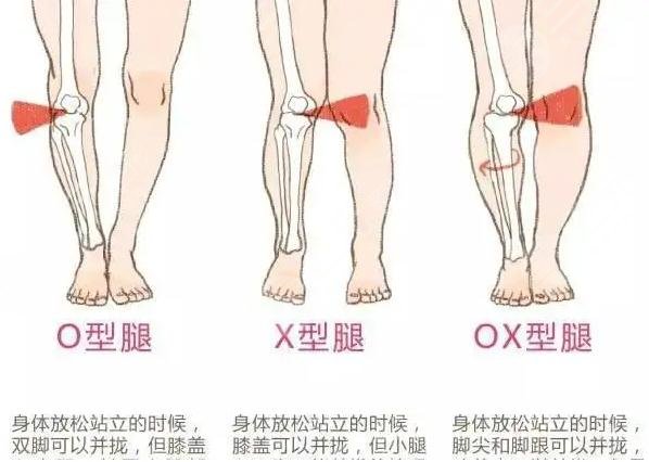 x型腿怎么矫正