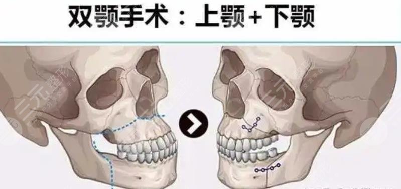 北京大学深圳医院正颌手术科普